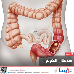 سرطان الكولون